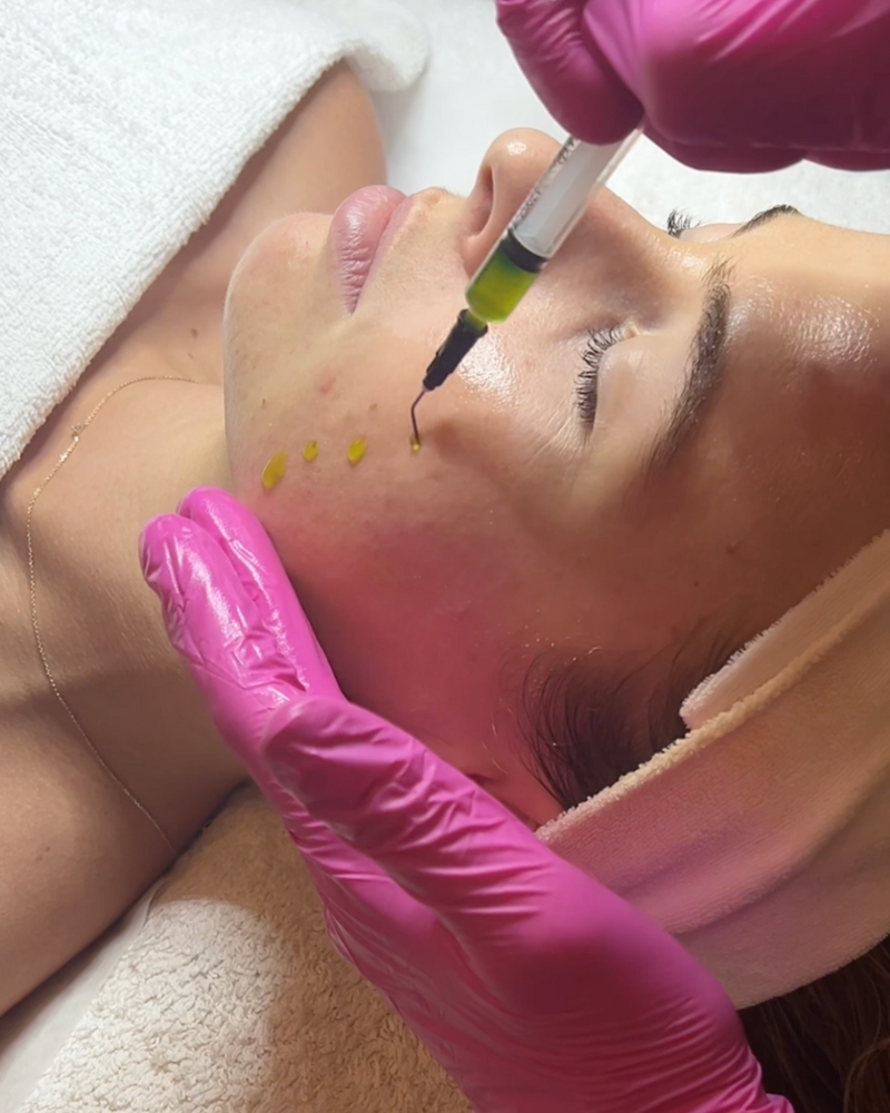 Customised Peels