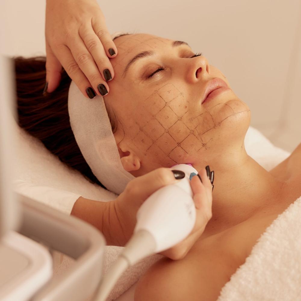 Thermage FLX - Full Face + Complementary Titanium Lifting